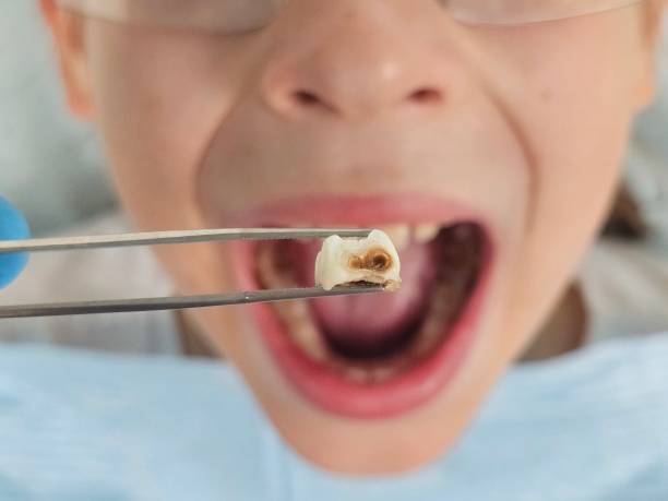 Best Emergency Tooth Extraction in Ashville, OH